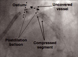 Figure 2. Following stent deployment, a postdilation balloon was advanced into the vessel. This secondary device caught the most proximal segment of the stent and compressed the deployed stent along its longitudinal axis. Significant shortening of the sten