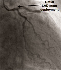 Figure 1. An elderly patient with ACS was treated with PCI for critical calcific proximal left anterior descending artery disease. Following high-speed rotational atherectomy, a drug-eluting stent was deployed at the ostium of this vessel.