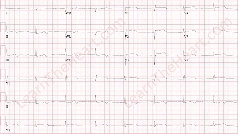 Hypothermia-ECG