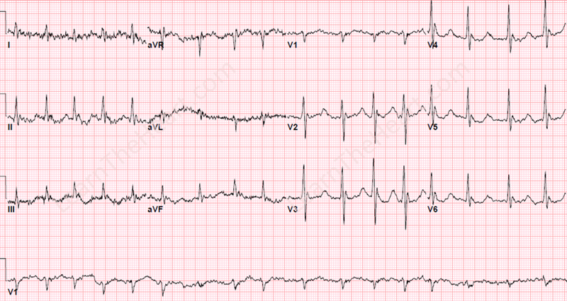 HypothermiaECGOsborneJwaves