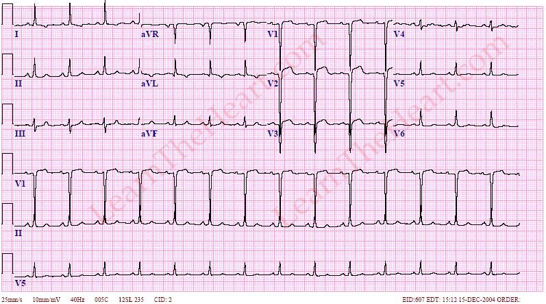 LV-Aneurysm