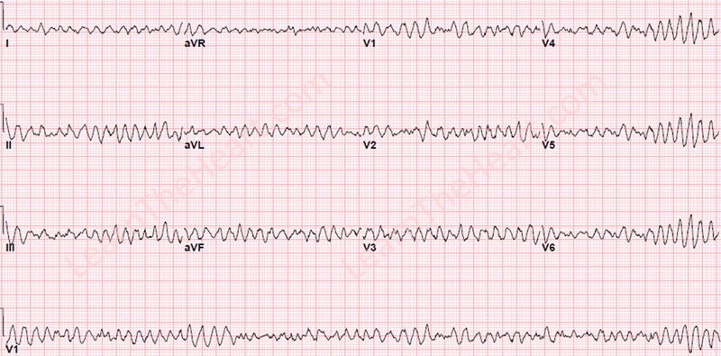 VentricularFibrillation-WM