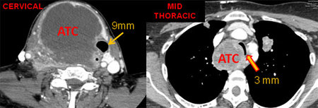 Figure 3. Axial CT scan with contrast of the cervical neck and mid-thorax.