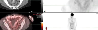 Clockwise from upper left: Axial CT, axial PET, fused axial PET-CT and maximal intensity projection 3 months later showed no evidence of metastatic implant in this region. The remainder of the scan showed significant improvement, consistent with positive response to therapy.
