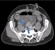 Axial CT image demonstrates an abrupt small bowel transition point in the pelvis at an area of extensive nodular soft tissue implants (arrows). End-colostomy is noted in the left lower abdomen. 