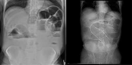 Upright abdominal radiograph (left) and CT scout image (right) demonstrate a high-grade small bowel obstruction.