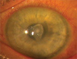 MRSA under a LASIK flap.