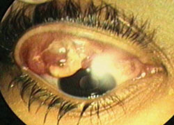 This image of another patient shows classic vernal conjunctivitis with ulceration. Because corneal ulcer can be a secondary effect of vernal conjunctivitis, treatment with a steroid-antibiotic combination is recommended.