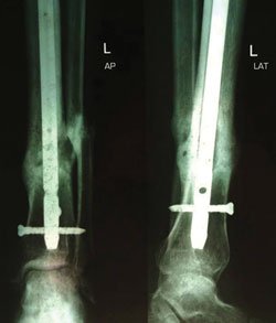 The fracture successfully united 24 weeks after injection of platelet-rich plasma concentrate