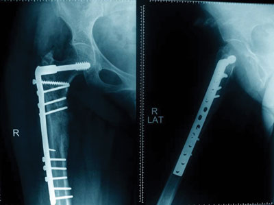 The fracture united at 20 weeks following injection.