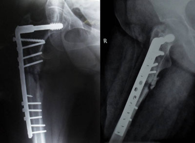 ubtrochanteric femur fracture treated with dynamic condylar screw and plate