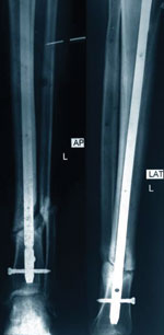 onunion fracture of both bones of the leg following treatment with an Interlocking nail