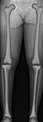 A normal adult male with 5º consitiutional varus