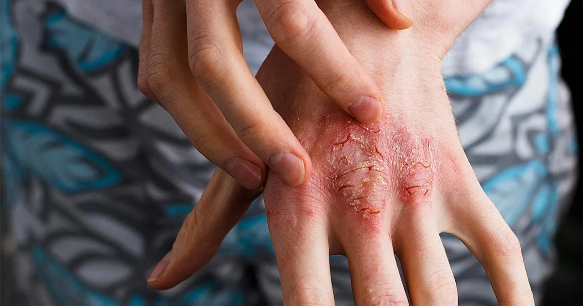 Psoriasis