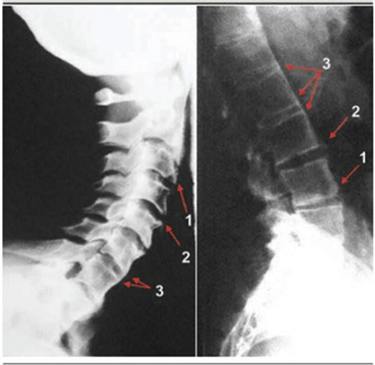 Figure 12-3: Modified Stoke Ankylosing Spondylitis Spine Score (mSASSS). Key: 0 = normal; 1 = erosion, sclerosis, or squaring; 2 = syndesmophyte; 3 = bridging syndesmophyte. Chronic spinal changes are assessed by scoring the anterior vertebral edge of each vertebra between the lower edge of C2 and the upper edge of T1, and between the lower edge of T12 and the upper edge of S1. Source: Braun J, Baraliakos X. Ann Rheum Dis. 2011;70(suppl 1):i97-i103.