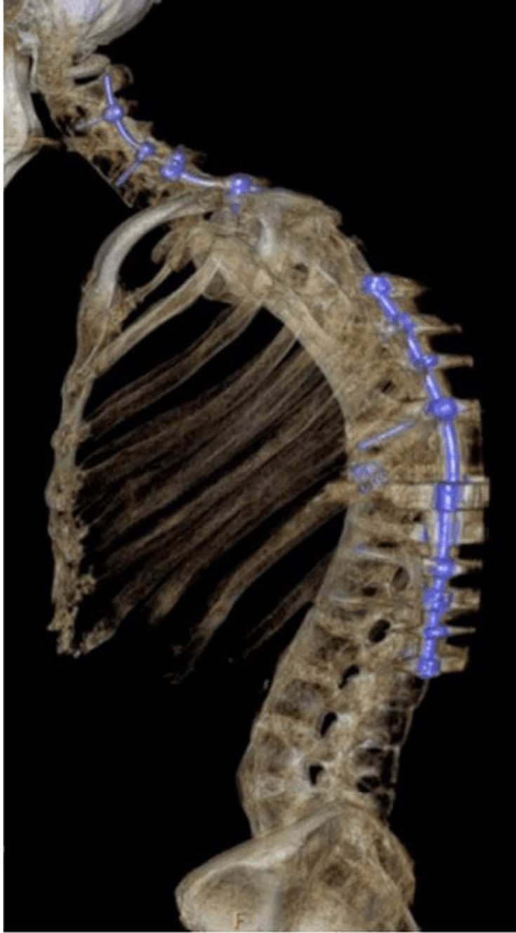 Figure 20-1: X-ray Showing Spinal Kyphosis and Surgical Fusion of Spinal Fractures. X-ray of thoracic and lumbar spine (lateral view) showing surgical fusion of a relatively recent spinal fracture between C7 and T1 vertebral bodies. The X-ray also partly shows previous spinal osteotomy at T10 and fusion from T5 to L2 by metal plates and screws.