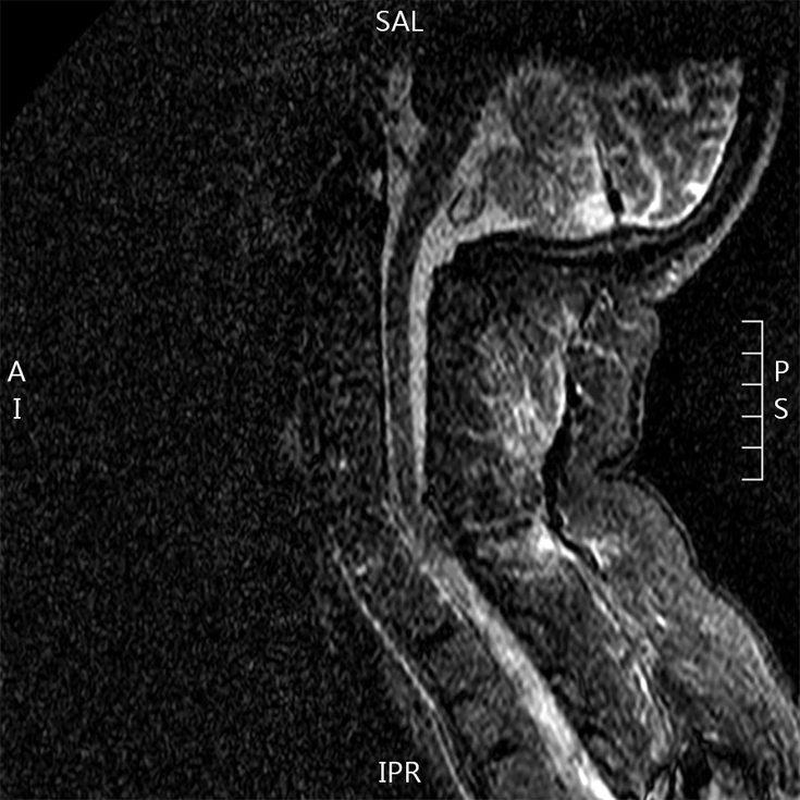 Figure 7-3: MRI Lateral View Showing Spinal Fracture Between C7 and T1. Source: Khan MA. Clin Rheumatol. 2016;35(6):1637-1641.