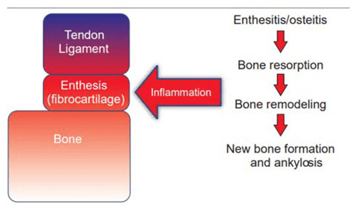 Figure 4-11: The Enthesitis and Sequence of Events in AS. The typical sites of inflammation are at the entheses (regions of high biomechanical stress where ligaments and tendons insert into bone) and at the adjacent subchondral bone marrow (osteitis). There is also reactive osteoproliferation that can ultimately progress to ankylosis at the involved sites.