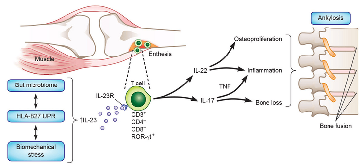 Figure 4-9: Model Showing Interplay of Factors Affecting CD4+ T-cell Differentiation and Their Likely Roles in AS Pathogenesis. Source: Lories RJ, McInnes IB. Nat Med. 2012;18(7):1018-1019.