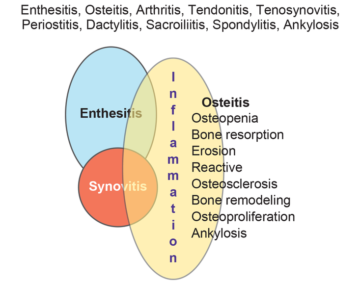 Figure 1-2: Synovio-Entheseal Complex Involvement and Resultant Clinical and Pathological Features of SpA. Source: Khan MA. In: Axial Spondyloarthritis. Mease P, Khan MA eds, Elsevier. 2020.