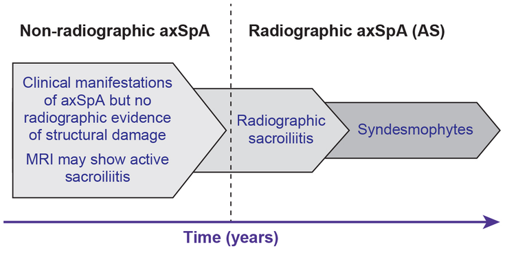 Figure 1-3: The Concept of axSpA. This figure schematically shows a unifying concept of axSpA that has a wide clinical spectrum. Inflammatory back pain is the leading symptom that may be present throughout the disease course without any occurrence of structural damage. As further explained in the text, the decreasing sizes of the three chevrons from the left to the right of this figure are meant to emphasize that only a portion of patients with nr‐axSpA will progress to r‐axSpA/AS, whereas others may remain as nr‐axSpA, perhaps forever or have a self‐limiting disease course. This figure also shows that not all patients with radiographic sacroiliitis progress to form syndesmophytes with resulting spinal ankylosis. Source:  Khan MA, van der Linden S. ACR Open Rheumatol. 2019;1(5):336-339.