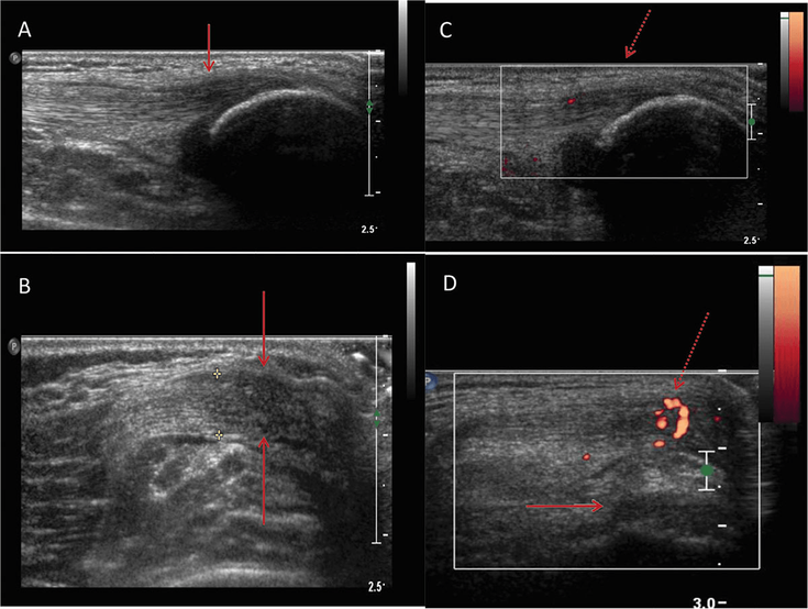 Figure 10-10: Enthesitis in Juvenile SpA. Quadriceps tendon enthesitis in a 12-year-old boy. (A) Long, grayscale ultrasound image demonstrates focal hypoechogenicity within the distal aspect of the quadriceps tendon (arrow) which is confirmed on the transverse image (B) with mild focal tendon enlargement (arrows) Long (C) and transverse (D) Power Doppler images demonstrate abnormal, increased signal within the tendon (dashed arrows) consistent with hyperemia. A small amount of joint fluid (arrow) is seen in D. Source: Gmuca S, Weiss PW. Curr Opin Rheumatol. 2015;27(4):364-372.