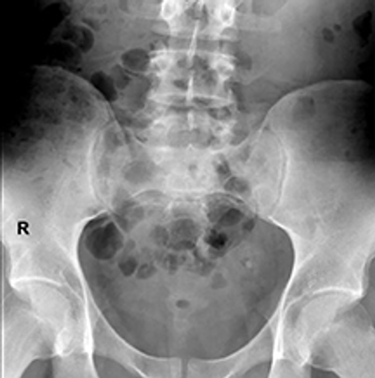 Figure 10-1A: Right Sacroiliac Joint of a Patient With Axial Spondyloarthritis.  Suspicious changes in the right sacroiliac joint of a patient with axial spondyloarthritis; subsequent MRI showed evidence of inflammation in that joint.