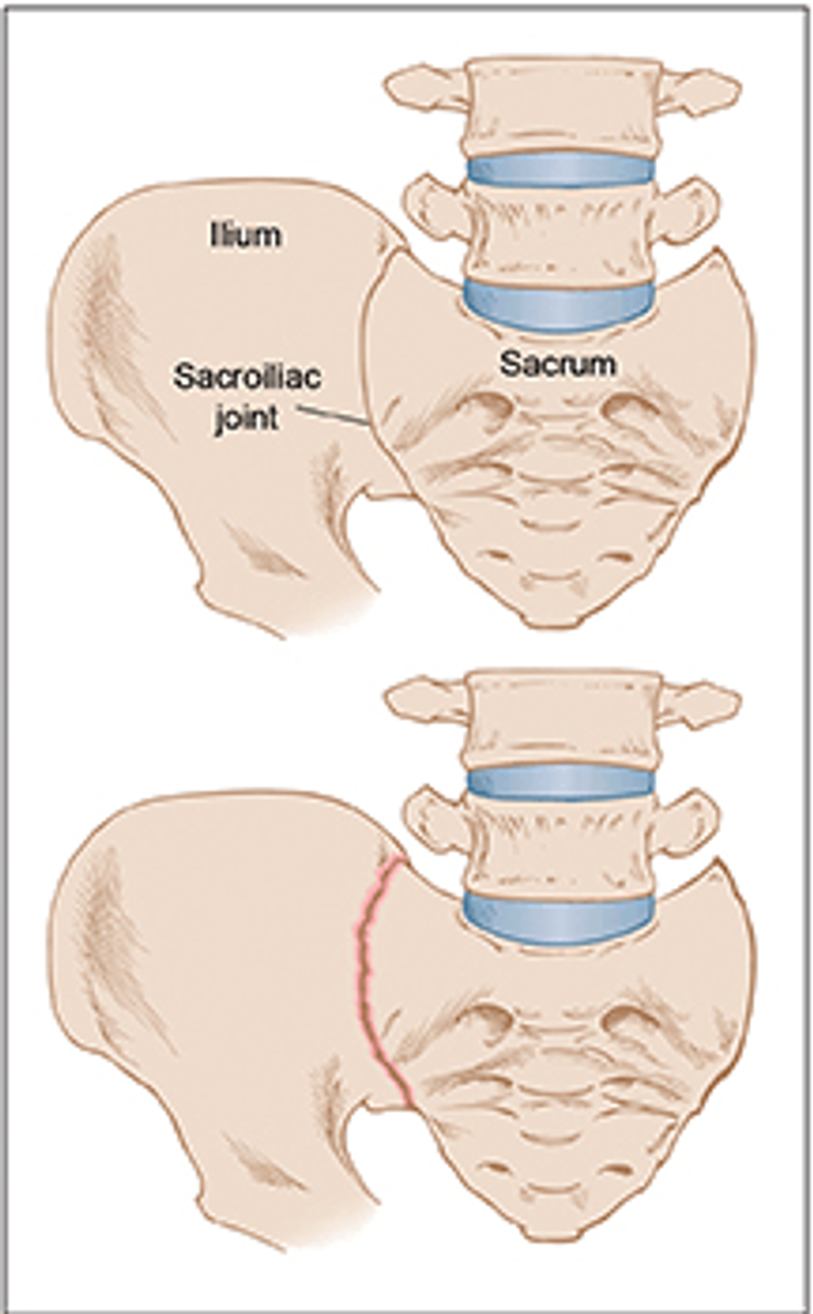 Figure 10-1B: Sacroiliitis. Schematic drawing showing the location of the sacroiliac joint; the red line depicts sacroiliitis. Source: Khan MA. Spondyloarthropathies. In: Hunder GG, ed. Atlas of Rheumatology. 4th ed. Philadelphia, PA: Current Medicine; 2005:151-180.