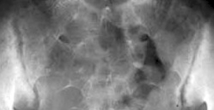 Figure 10-2: Anteroposterior Roentgenographic View of Pelvis Showing Bilateral Sacroiliitis in AS. Erosions and blurring of the subchondral bone plate and reactive bone sclerosis are more prominent on the iliac side of the joint (Ferguson view). Source: Khan MA. Spondyloarthropathies. In: Hunder GG, ed. Atlas of Rheumatology. 4th ed. Philadelphia, PA: Current Medicine; 2005:151-180.