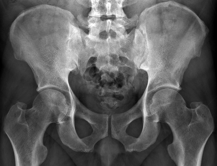 Figure 10-3: Partial Ankylosis of the Right Sacroiliac Joint of a Patient With Spondyloarthritis and Recurrent Episodes of Acute Anterior Uveitis. Source: Provided with permission Courtesy of Dr. Mazen Elyan.