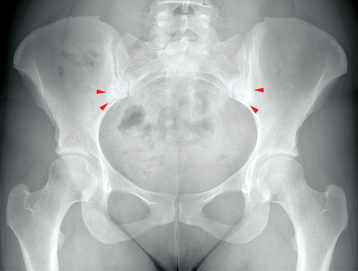 Figure 10-4: Pelvic Radiograph Showing Osteitis Condensans Ilii.  Pelvic radiograph shows osteitis condensans ilii (red arrowheads) on 32-year-old, HLA-B27–negative woman with persisting inflammatory back pain starting in the second trimester of her first pregnancy. Source: Weber U, et al. Curr Rheumatol Rep. 2016;18(9):58.