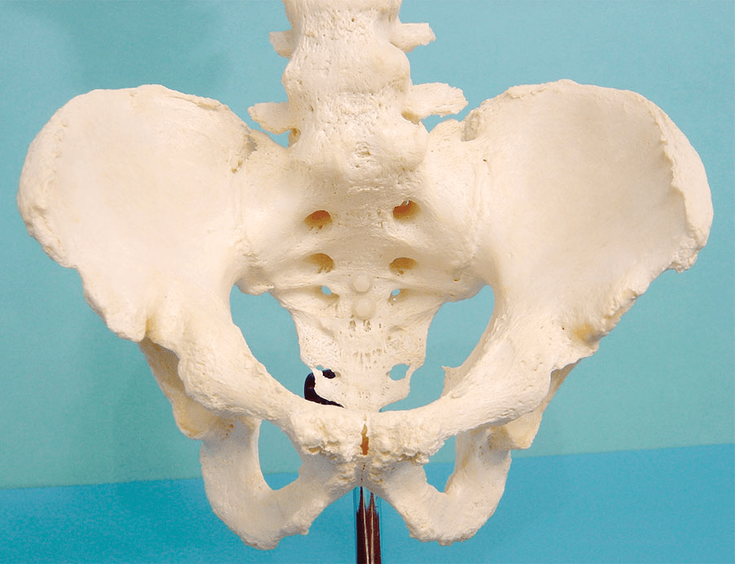 Figure 10-5: Actual Specimen of the Pelvis of a Patient With Advanced Long-Standing AS.  There is complete ankylosis of both sacroiliac joints and the fourth and fifth lumbar vertebrae. Moreover, there is almost complete fusion of his public symphysis. Source: Permission provided courtesy of Dr. Heinz Baumberger and the “Schweizerische Vereinigung Morbus Bechterew” (SVMB) or the Swiss Ankylosing Spondylitis Society in English.