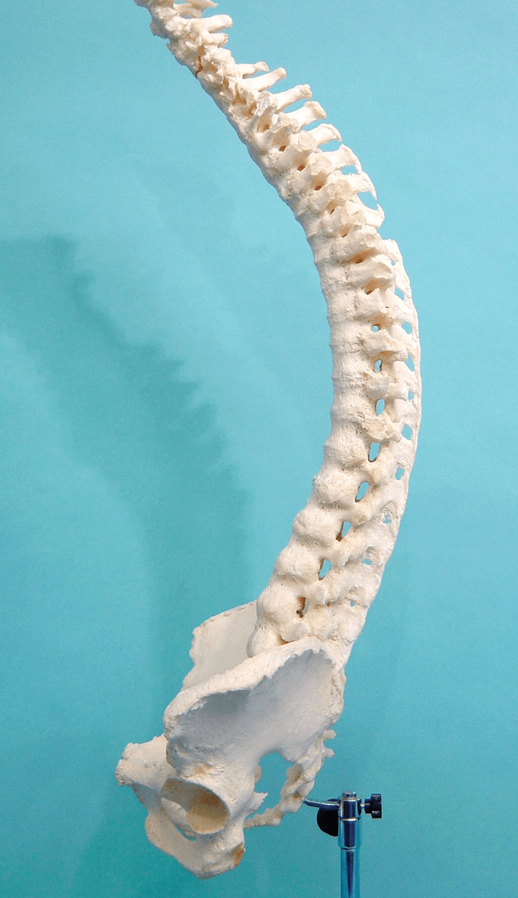 Figure 10-6: Actual Specimen of the Axial Skeleton of the Same Patient Whose Pelvis is Shown in Figure 10-5. There is marked kyphosis with complete fusion (‘bamboo spine’) of the whole spine (including the facet joints and even the interspinous ligaments) but sparing of the intervertebral fossa. Red line in the cervical spine marks the site of the neck fracture that lead to his death. Source: Permission provided courtesy of Dr. Heinz Baumberger and the “Schweizerische Vereinigung Morbus Bechterew” (SVMB) or the Swiss Ankylosing Spondylitis Society in English.