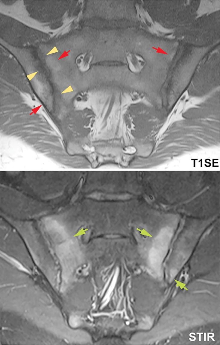 Figure 10-7: Morphology of the Most Relevant Lesion Types on Sacroiliac Joint Coronal Oblique MRI in Early Axial Spondyloarthritis. 21-year-old, HLA-B27–positive male patient with inflammatory back pain for 3 years. The MRI shows extended BME (green arrows) predominantly on the sacral side of both SI joints on the STIR sequence (bottom). The T1 Spin Echo (T1SE) sequence (top) displays fat metaplasia (red arrows) mainly in the right SI joint within and outside areas with BME. Erosion (yellow arrowheads) in the right SI joint can be demonstrated already at this early disease stage. Source: Weber U, et al. Curr Rheumatol Rep. 2016;18(9):58.