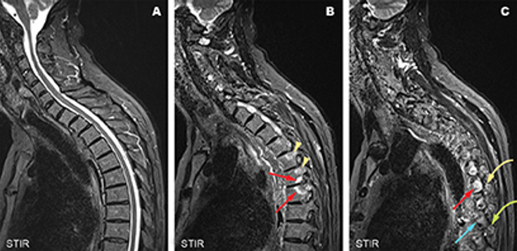 Figure 10-8: Spinal MRI Can Identify SpA-Associated Inflammation.  Three MRI images with STIR sequence applied of a 48-year-old, HLA-B27–negative male patient with AS who presented with interscapular pain on deep breathing and rotation of the trunk. (A) A central MRI slice, showing the central spinal canal, without inflammation. (B) A lateral MRI slice through the pedicles displays BME in the fifth and sixth thoracic vertebra, representing costovertebral joint inflammation (red arrows). In addition, BME is visible in pedicles (yellow arrowheads). (Cw) A far lateral MRI slice shows BME both in the rib (red arrow) and transverse process (yellow arrow), corresponding to costotransversal joint inflammation. See a normal rib (blue arrow) and transverse process (green arrow) for comparison. Inflammatory lesions in the lateral spinal compartment (costovertebral, costotransverse, and facet joint) are highly specific for SpA and can be captured by dedicated spinal MRI protocols for SpA that include lateral slices. Source: van Tubergen A, Weber U. Nat Rev Rheumatol. 2012;8:253-261.