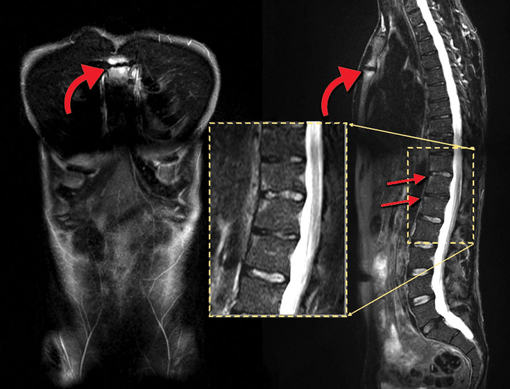 Figure 10-9: The Whole-Body MRI (STIR technique) Coronal and Sagittal Sections in a Patient With Ankylosing Spondylitis. Curved red arrows indicate inflammation of the manubriosternal articulation and straight red arrows point to corner lesion BME that is better visualized  on the magnified insert. Source: Weber U, et al. Intl J Adv Rheumatol. 2007;5:2-7.