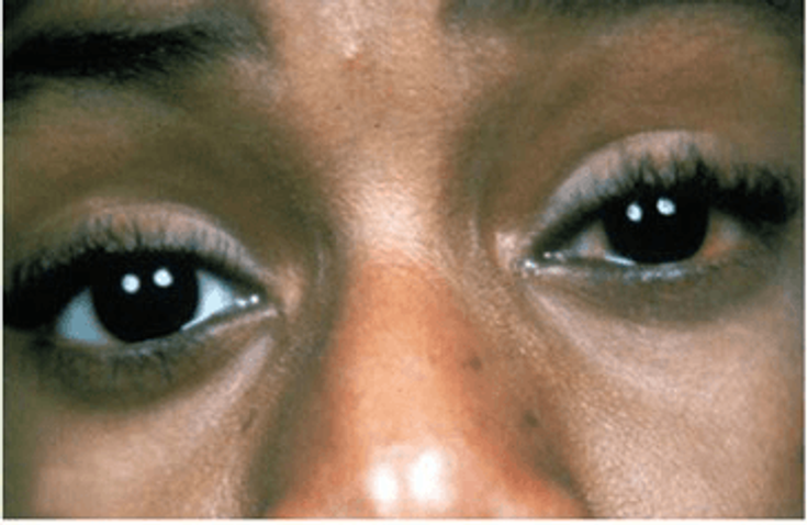 Figure 7-2: Acute Anterior Uveitis: Illustrates Circumcorneal Congestion and Lacrimation. Source: Khan MA. Spondyloarthropathies. In: Hunder GG, ed. Atlas of Rheumatology. 4th ed. Philadelphia, PA: Current Medicine; 2005:161.