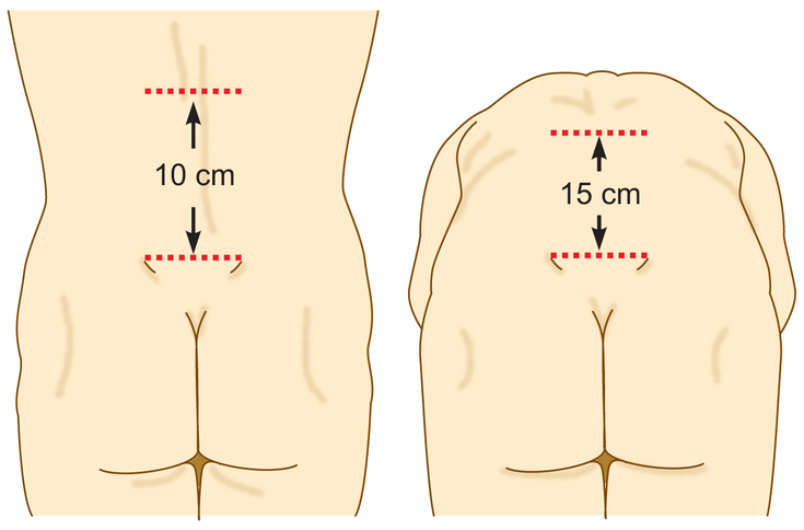 Figure 8-3: Modified Schober’s Test of Lumbar Flexion. Lumbar spinal flexibility is determined by modified Schober’s test in which a mark is placed on the skin in the midline of the back at the level of the superior iliac spine; a second mark is placed 10 cm above in midline with the patient standing erect with knees fully extended (left). The patient is then asked to maximally bend forward without bending the knees. The distance between the two skin marks is stretched to 14 cm or more if spinal flexibility is normal (right). Source: Khan MA. Spondyloarthropathies. In: Hunder GG, ed. Atlas of Rheumatology. 4th ed. Philadelphia, PA: Current Medicine; 2005:151-180.