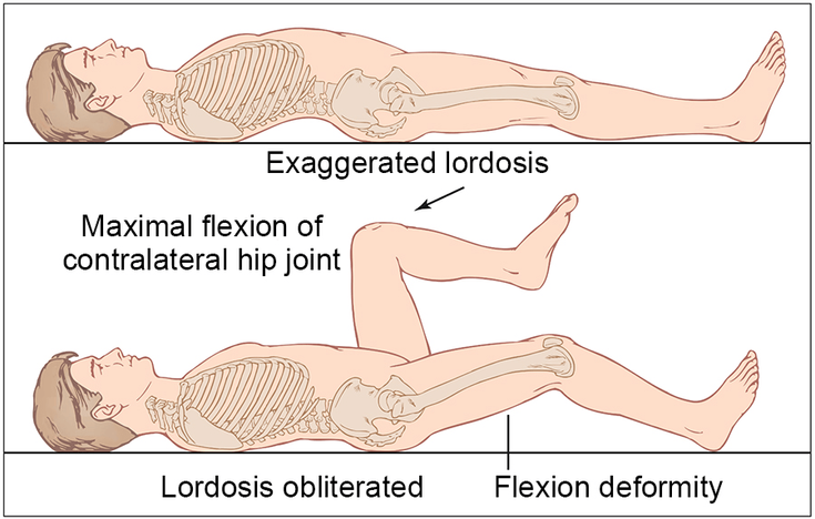 Figure 8-5: Detection of Flexion Contracture of the Hip Joints Flexion contractures of the hip are not uncommon at later stages of the disease and can be easily detected by having the patient lie on a very firm examining table and flexing one hip joint maximally to bring out the contracture in the contralateral hip joint. Source: Khan MA. Spondyloarthropathies. In: Hunder GG, ed. Atlas of Rheumatology. 4th ed. Philadelphia, PA: Current Medicine; 2005:151-180.