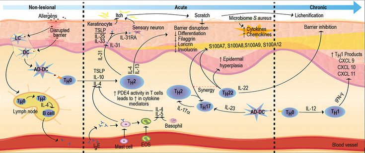 Figure 10-1: Immunologic Pathways Involved in the Pathogenesis of Acute AD and Progression to Chronic AD. Source: Adapted from Vakharia PP, Silverberg JI. <em>BioDrugs.</em> 2017;31(5):409-422. Illustrated by Miki Fujiwara.