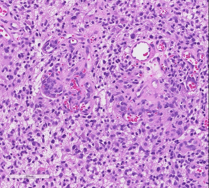 Figure 1-20: 10/31/16: Right frontal resection. Regions of viable recurrent glioblastoma with proliferating malignant astrocytic glia and glomeruloid vasculature.