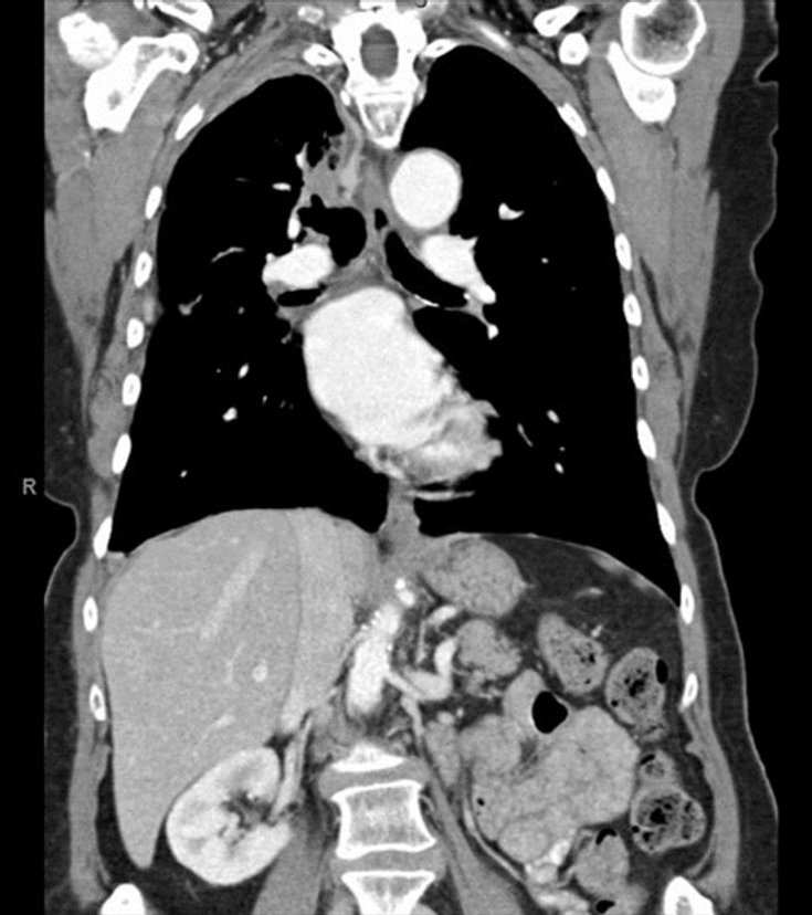 Figure 1-4: 1/31/15: stable disease with acquired EGFR T790M mutation, continued on afatinib+cetuximab