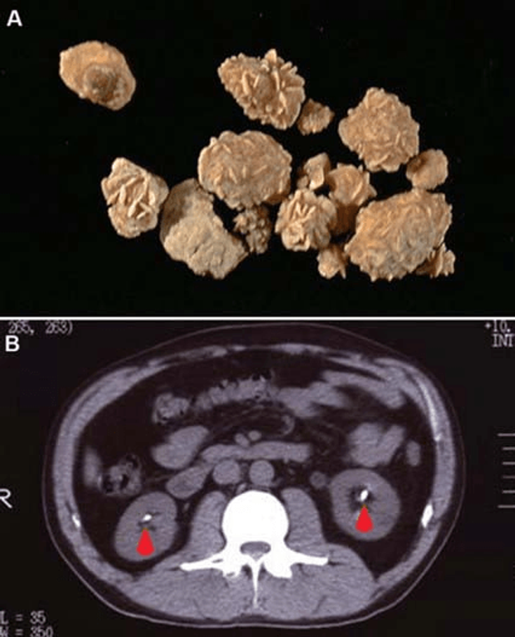 Figure 3-10:  Uric Acid Urolithiasis.  Uric acid stones appearance after extraction of renal uric acid stones (A), appearance of uric acid urolithiasis on CT (B) (red arrows): insoluble precipitates of uric acid (not MSU) are produced when the concentration of uric acid exceeds solubility. Urinary uric acid supersaturation also promotes calcium oxalate urolithiasis. Risk factors for uric acid urolithiasis include hyperuricemia, acid urine pH, gout, and metabolic syndrome (which promotes acid urine pH). Images courtesy of emedicine.medscape.com and urologystone.com.