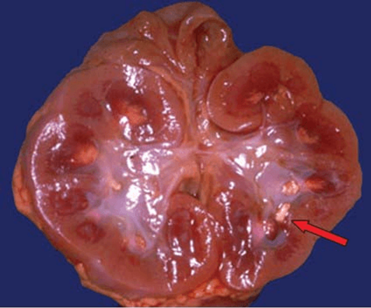 Figure 3-11: Chronic Urate Nephropathy (Gouty Nephropathy).  Sustained hyperuricemia causes interstitial urate crystal deposition1; inflammation, fibrosis, and renal insufficiency follow. At autopsy, unsuspected pathologic evidence of renal interstitial urate crystal urate deposition remains more common than generally appreciated in gout patients.2,3 However, functionally significant chronic urate nephropathy now appears uncommon in this era of potent antihyperuricemic and antihypertensive therapies. Tophaceous deposits in the renal medulla (arrow) are caused by urate nephropathy. Sources: 1) Beck LH. Kidney Int. 1986;30(2):280-287. 2) Kang DH, Nakagawa T. Semin Nephrol.  2005;25(1):43-49. 3) Tarng DC, et al. Am J Nephrol. 1995;15(1):31-37.