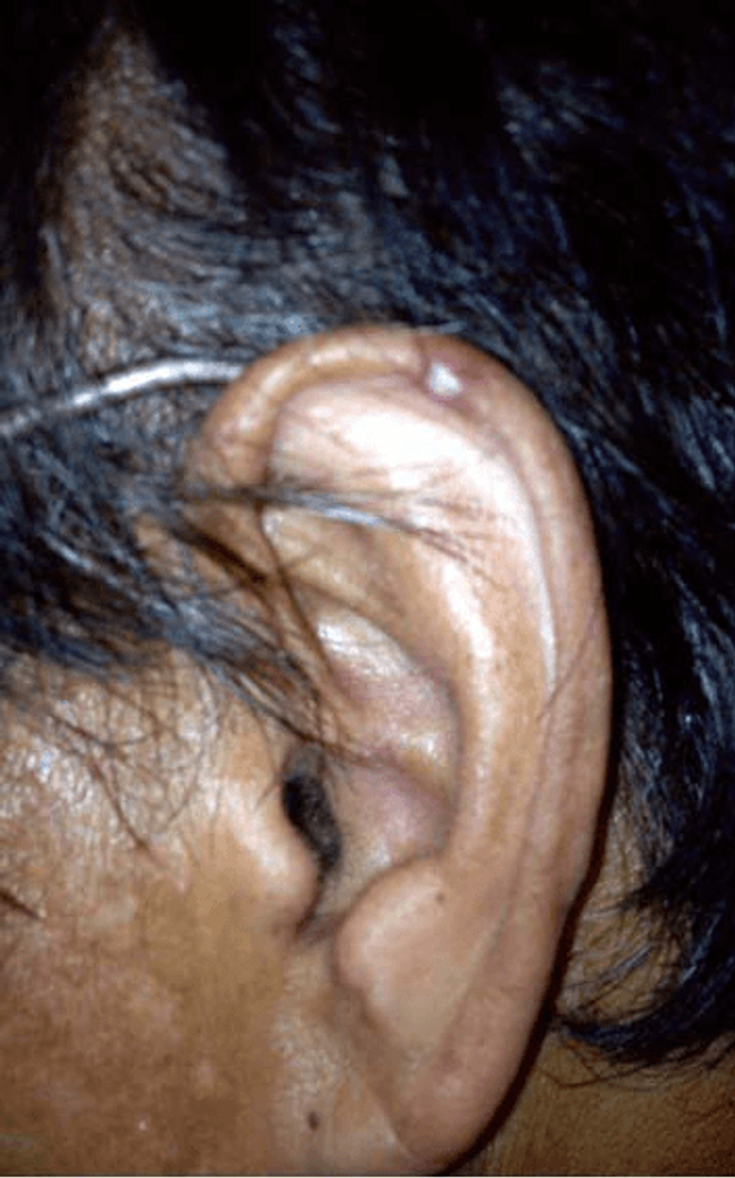 Figure 3-4: Ear Tophus