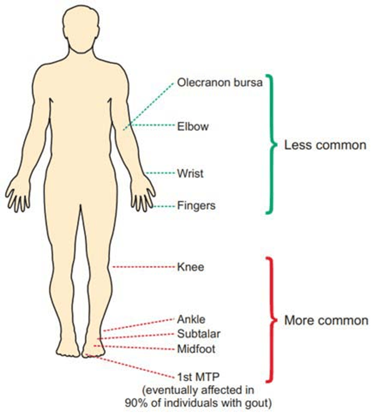 Figure 3-5: Common Sites of Acute Gout Involvement