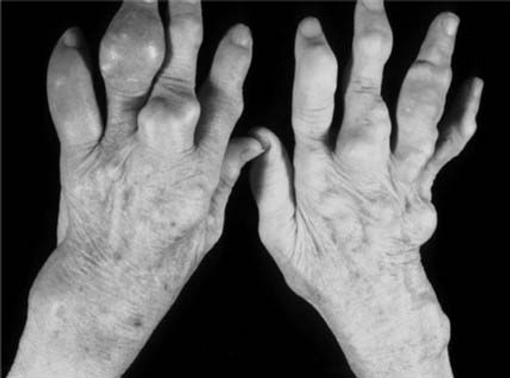 Figure 3-6: Advanced Gouty Arthritis With Multiple Tophi