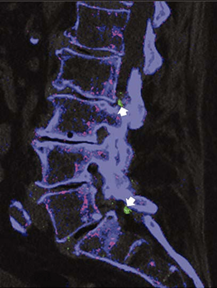 Figure 3-9: Dual-Energy Computed Tomography Scan of the Spine Showing Focal Uric Acid Deposits.  Focal uric acid deposits, depicted in green (white arrows), that are associated with L2-L3 and L5-S1 facet joints. Source: Parikh P, et al. J Rheumatol. 2010;37:2190-2191.