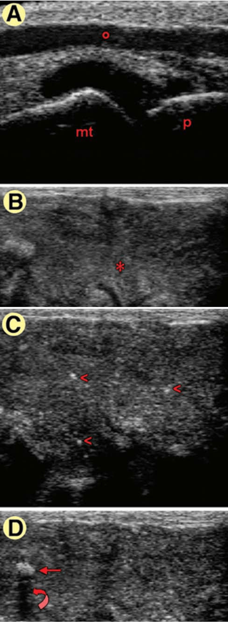 Figure 4-13: Acute Gout: First Metatarsophalangeal Joint. Predominantly anechoic joint cavity widening (A); metatarsal bone (mt), proximal phalanx (p), vein (o). Homogeneous punctate pattern (B) of “urate sand” (*).  “Snowstorm” pattern (C) characterized by rounded aggregates of variable echogenicity (arrowheads), superimposed on “urate sand.” Large hyperechoic urate crystal tophaceous deposit (D, arrow) casting a posterior acoustic shadow (curved arrow). These images were obtained with a Diasus (Dynamic Imaging; Livingstone, UK) using an 8- to 16-MHz linear probe. Source: Grassi W, et al. Semin Arthritis Rheum. 2006;36(3):197-202.