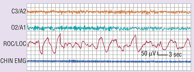 Figure 2-2: Polysomnography of Wake to Sleep Transition.  Notes: The most marked change is visible on the two electroencephalographic (EEG) channels (C3/A2 and O2/A1), where a clear pattern of rhythmic α activity (8 cps) changes to a relatively low-voltage, mixed-frequency pattern at about the middle of the figure. The level of electromyographic (EMG) activity does not change markedly. Slow eye movements (right outer canthus [ROC]/left outer canthus [LOC]) are present throughout this episode, preceding the EEG change by at least 20 seconds. In general, the change in EEG patterns to stage N1 as illustrated here is accepted as the onset of sleep. Source: Kryger MH, et al, eds. <em>Principles and Practice of Sleep Medicine. 7th ed. </em>Philadelphia, PA: Elsevier Saunders; 2022.